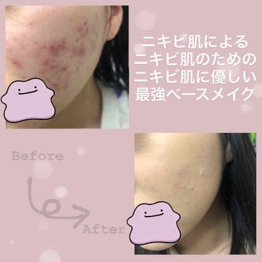 CLINIQUE アクネ カバーアップ リキッドのクチコミ「🍑頑固なニキビ肌の私が毎日やっている最強ベースメイク🍑﻿
﻿
初めまして!!﻿
何をしても治ら.....」（1枚目）