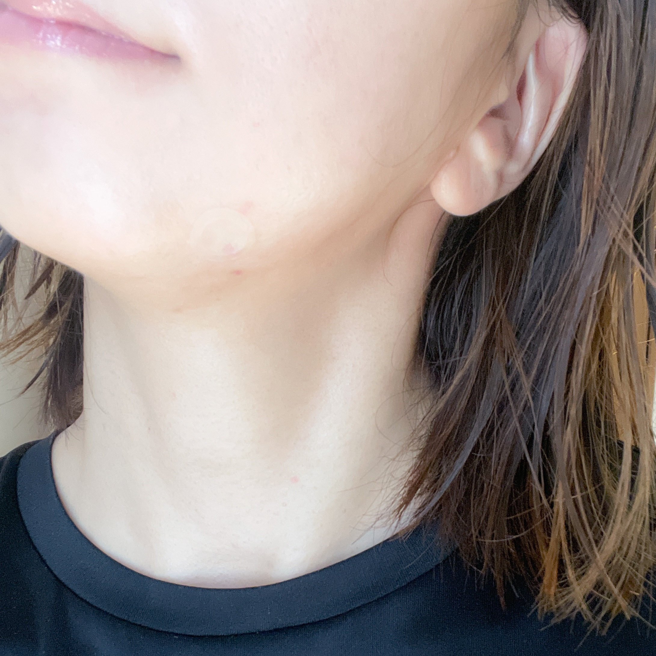 エーキュアショットスポットパッチ/obsero/にきびパッチを使ったクチコミ（3枚目）