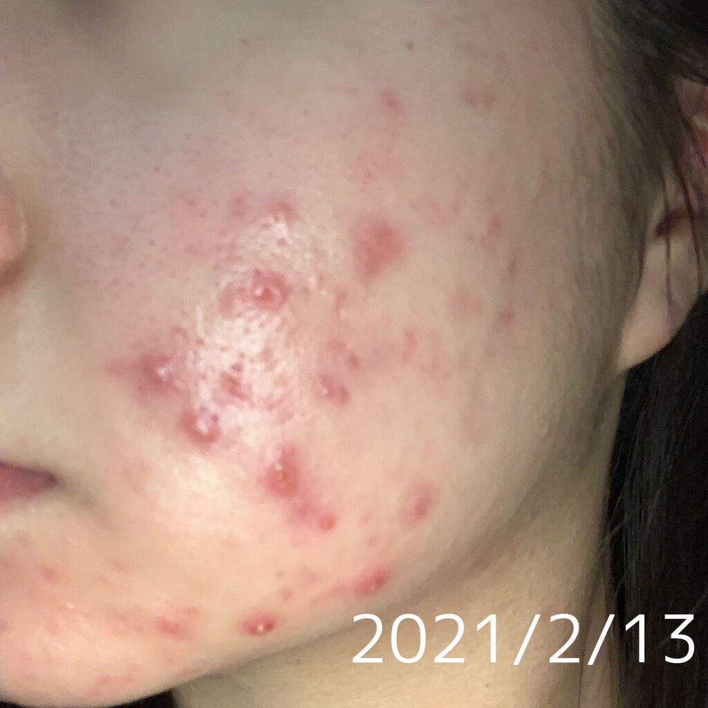 潤浸保湿 化粧水 III とてもしっとり/キュレル/化粧水を使ったクチコミ（3枚目）