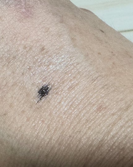 CICA method RECOVER PATCH/コジット/その他スキンケアを使ったクチコミ(6枚目)