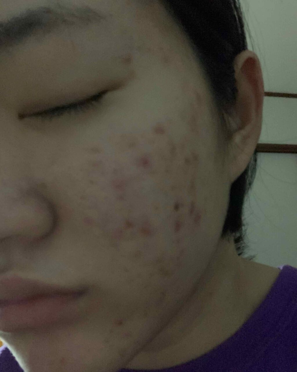 ベピオゲル/マルホ株式会社/その他を使ったクチコミ（3枚目）