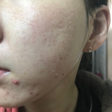 ゼロスポットパッチ/Today’s Cosme/にきびパッチを使ったクチコミ(2枚目)