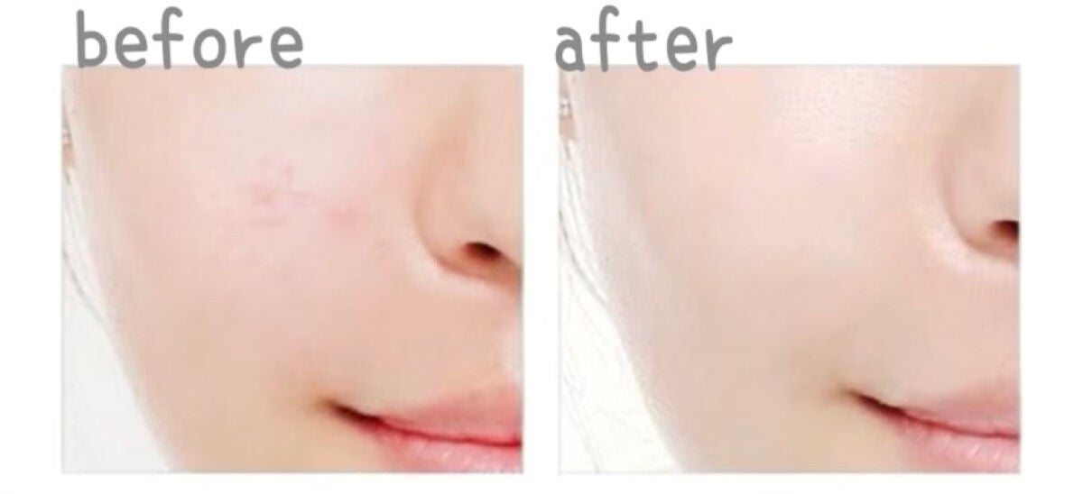 アクニドクターファーストスピーディースポット/ISOI/美容液を使ったクチコミ(3枚目)