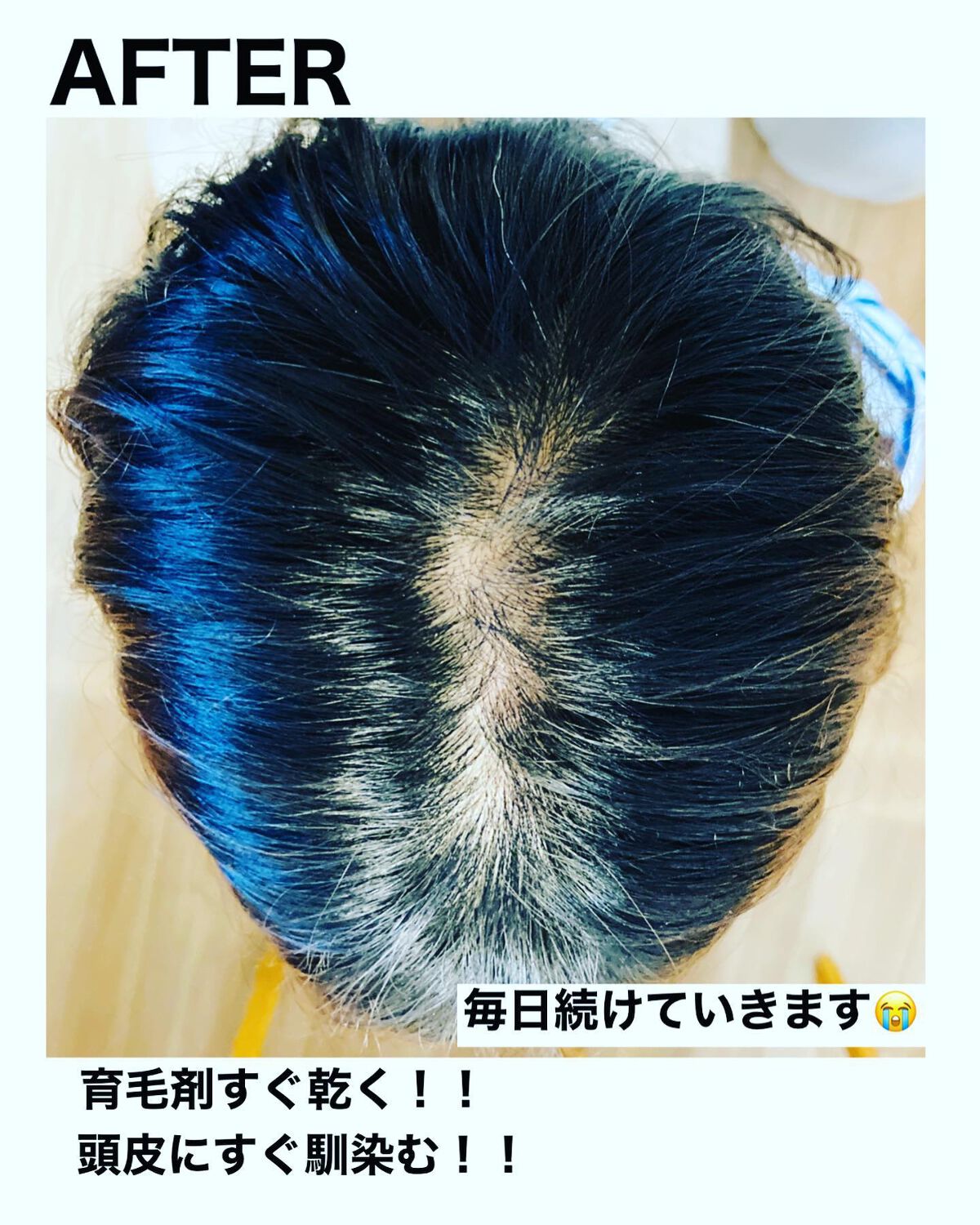 薬用スカルプエッセンス/HAIRICHE/頭皮ローションを使ったクチコミ(6枚目)