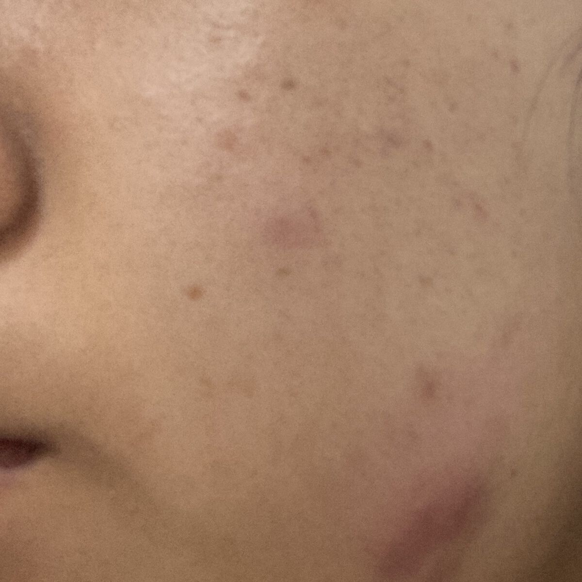 P.D.F A.Cドレッシングアンプルマスク EX/MEDIHEAL/シートマスク・パックを使ったクチコミ（3枚目）