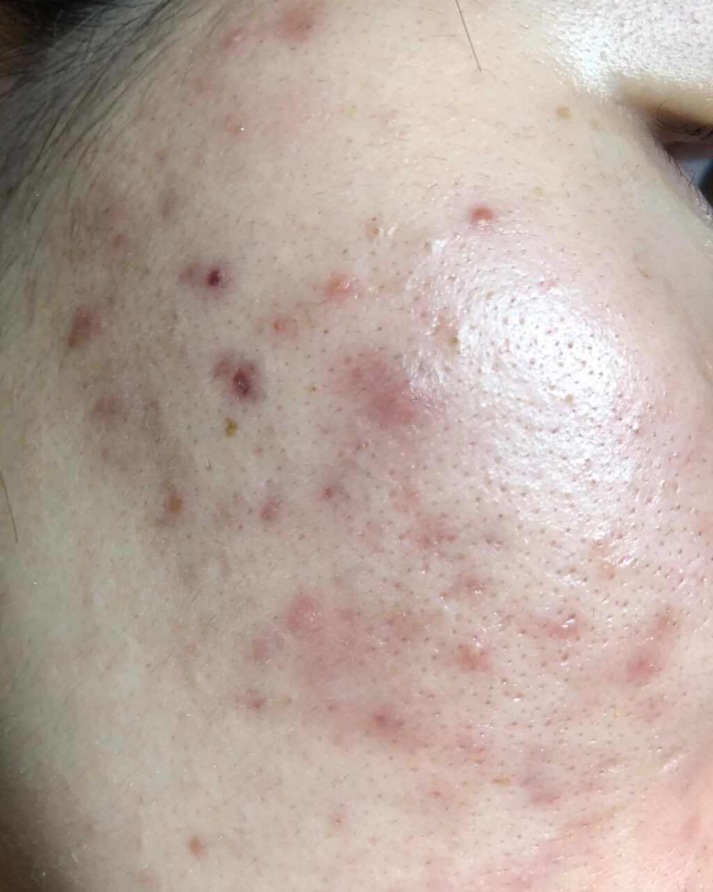 しろさい on LIPS 「初投稿です。今まで様々なものを使ってきましたが、なかなか治りま..」(2枚目)