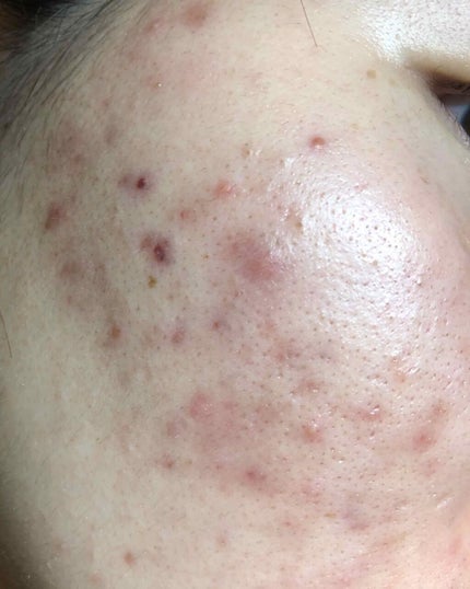 しろさい on LIPS 「初投稿です。今まで様々なものを使ってきましたが、なかなか治りま..」(2枚目)