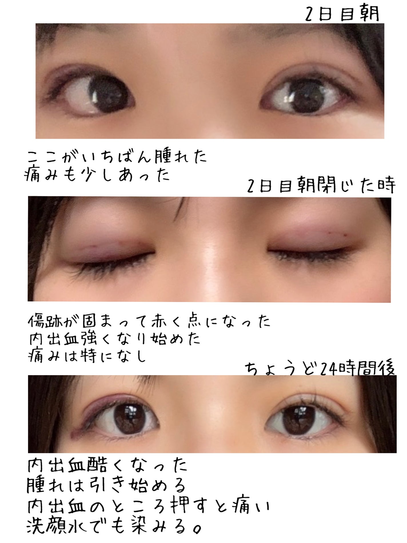 ぺこじゅん on LIPS 「【埋没法直前からダウンタイム2日目まで編】聞きたいこと、気にな..」(4枚目)