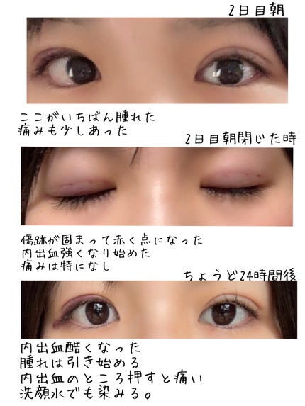 ぺこじゅん on LIPS 「【埋没法直前からダウンタイム2日目まで編】聞きたいこと、気にな..」(4枚目)