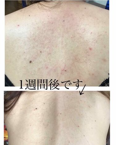 艶肌ドロップ ラッシュを使った口コミ まずお先に 2枚目の写真だいぶ汚いです By のありん 脂性肌 代前半 Lips 艶肌ドロップ ラッシュを使った口コミ まずお先に 2枚目の写真だいぶ汚いです By のありん 脂性肌 代前半 Lips
