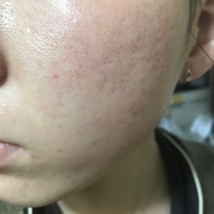 Azelaic Acid Suspension 10%/The Ordinary/美容液を使ったクチコミ(2枚目)