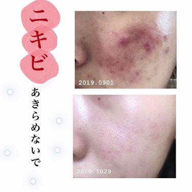 スキンケア方法 いつかの石けん 水橋保寿堂製薬の使い方 効果 写真は約一年前の肌と最 By M A I M U Lips
