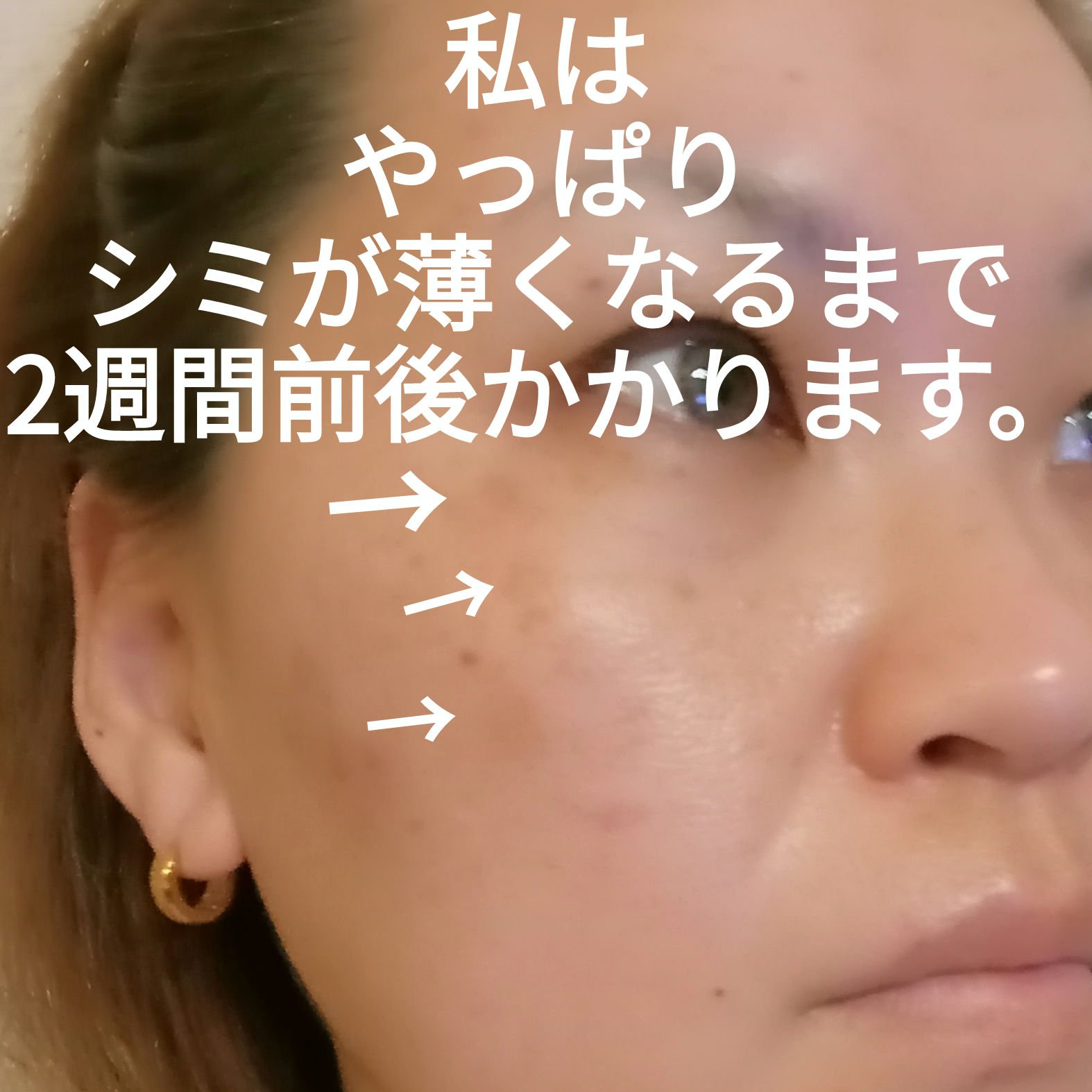 IPLフォトダブル/湘南美容/その他を使ったクチコミ（2枚目）