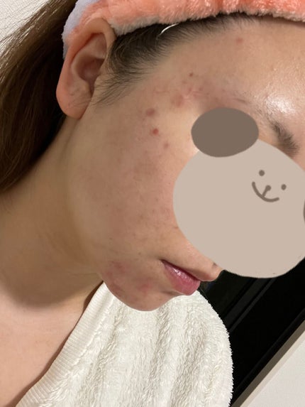 ペアアクネクリームW(医薬品)/ペア/その他を使ったクチコミ(4枚目)