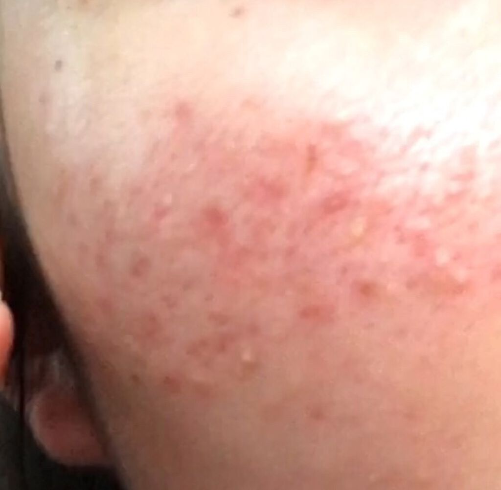 薬用アクネ ウォッシュ/クレンジングリサーチ/洗顔フォームを使ったクチコミ（1枚目）