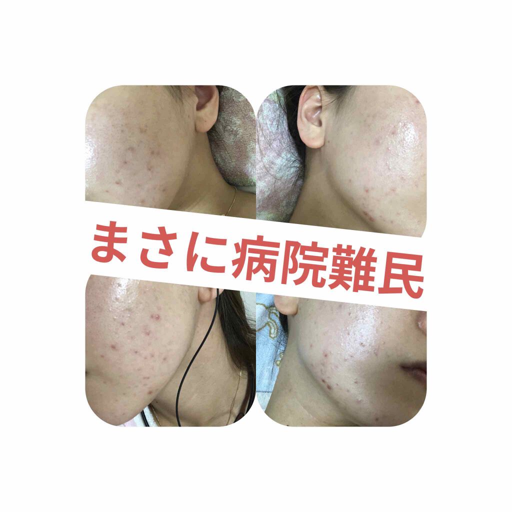 ペアアクネクリームW(医薬品)/ペア/その他を使ったクチコミ(1枚目)