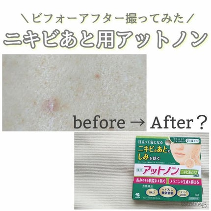 ニキビあとケアジェル/アットノン/その他スキンケアを使ったクチコミ(1枚目)