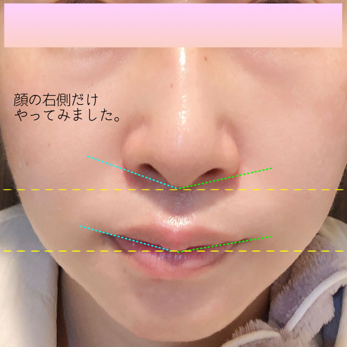 二重になる方法》AGE-R専用ジェルセラム｜MEDICUBEの使い方や二重