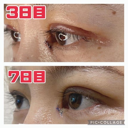 ふうせん @フォロバ100% on LIPS 「3月2日7日目写真で比べると違いがめっちゃわかる❣️❣️赤みは..」(4枚目)