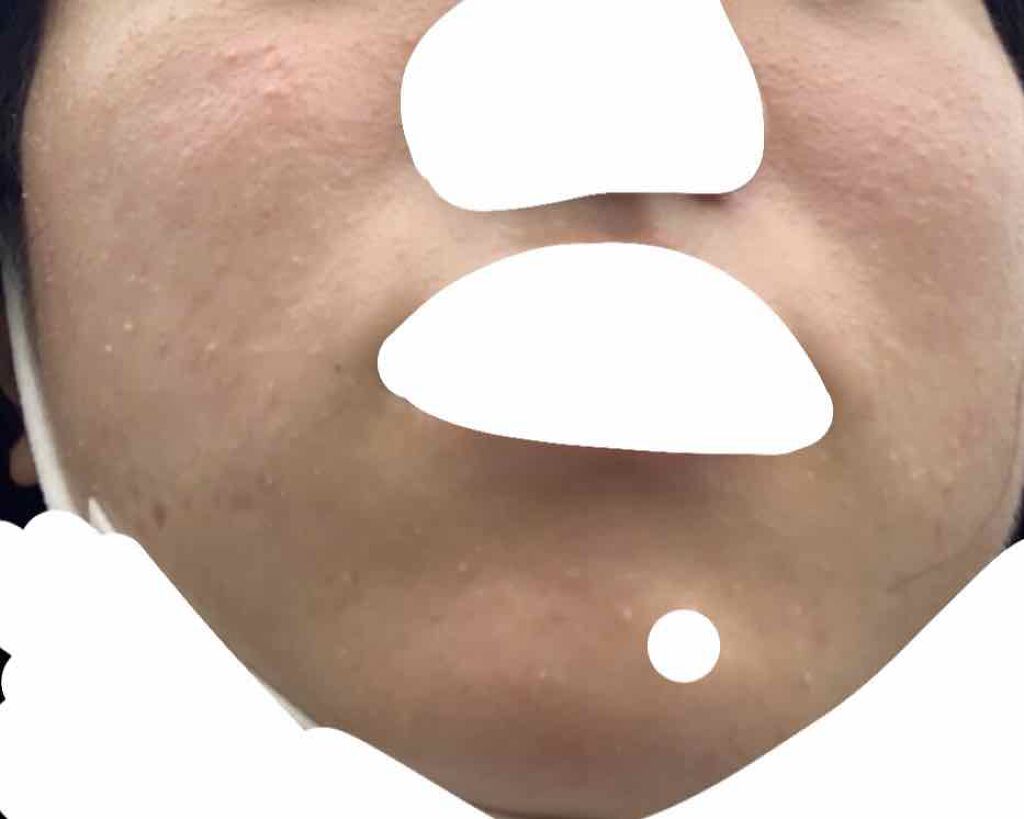 supreme_blush_zg3 on LIPS 「肌荒れに悩んでいます、、。自分の肌が汚いなと思い始めたのは中学..」(1枚目)