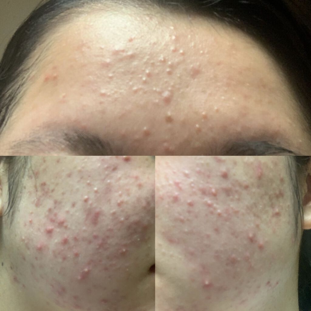 肌荒れ改善 on LIPS 「2021/09/06こんなたくさんニキビができたことがないので..」(1枚目)