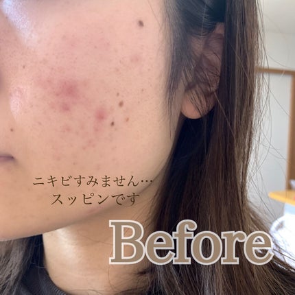 【旧】ディオールスキン フォーエヴァー スキン コレクト コンシーラー/Dior/リキッドコンシーラーを使ったクチコミ(5枚目)