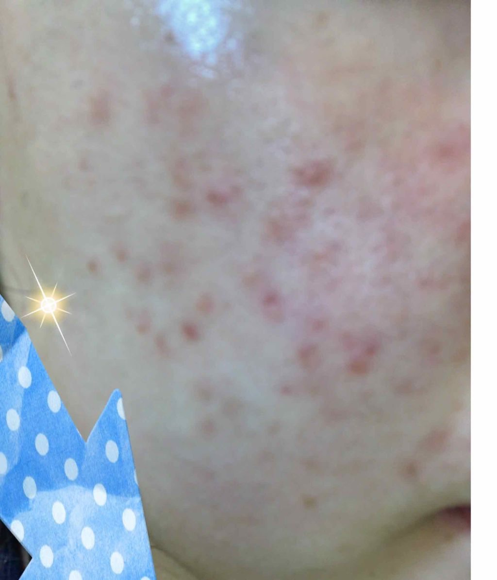 ベピオゲル/マルホ株式会社/その他を使ったクチコミ（2枚目）