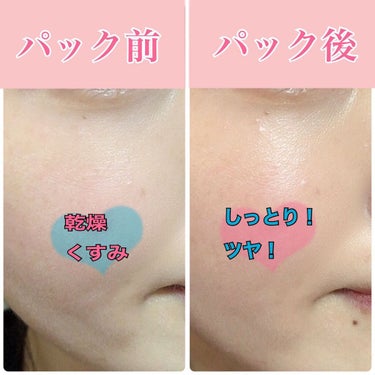 SUIKO HC ビタミン5エッセンスマスク/SUIKO HATSUCURE/シートマスク・パックを使ったクチコミ（5枚目）