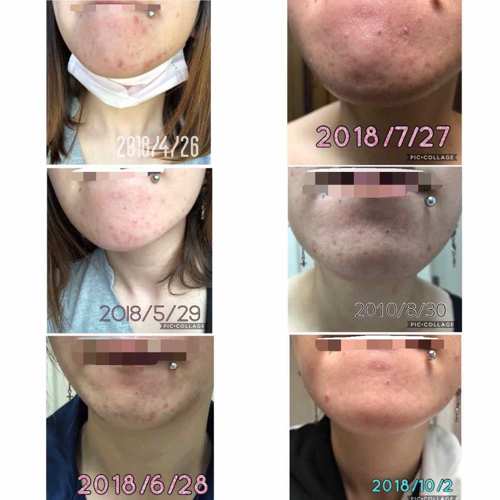 ペアアクネクリームW(医薬品)/ペア/その他を使ったクチコミ(3枚目)