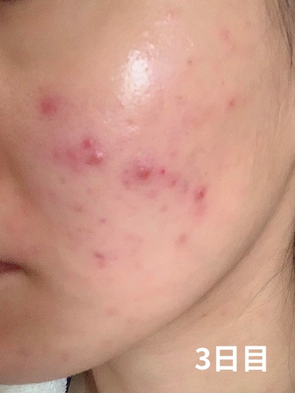 Tð on LIPS ããããæ²»çè¬ã¢ã¯ã¢ãã ã¯ãªãŒã ã®çµéã§ãðå¡ãå§ããŠãã1é±é..ãïŒ3æç®ïŒ