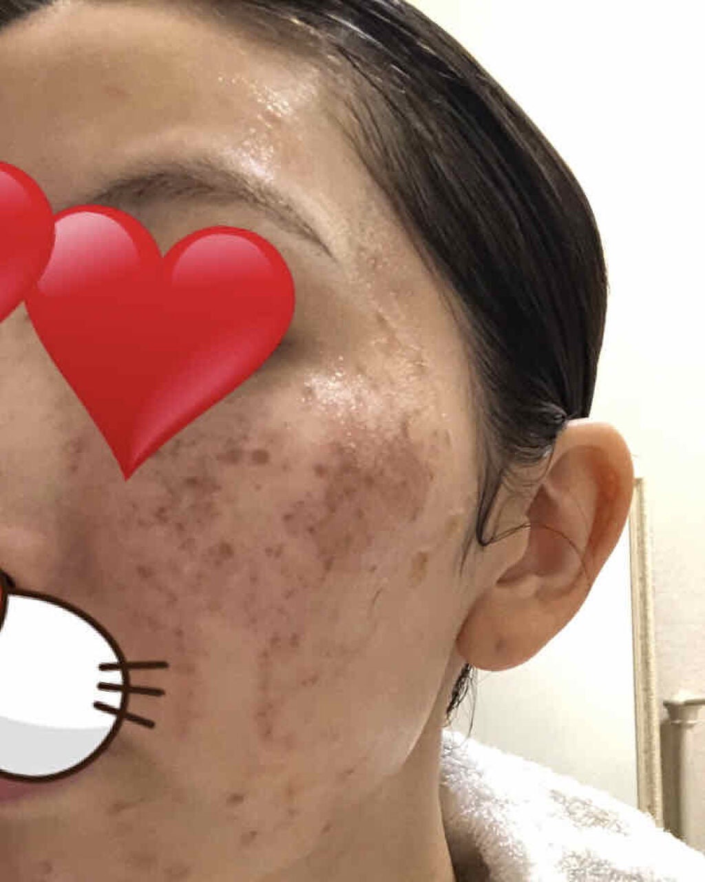 ねこ村 on LIPS 「レーザー照射2日目皮膚が爛れてこれは仕事休みでよかった〜という..」(3枚目)
