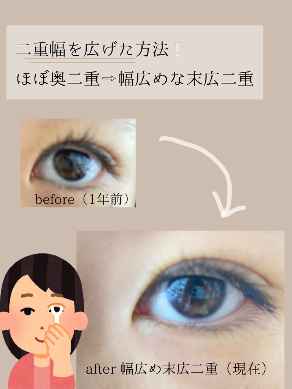 アイテープ(絆創膏タイプ、レギュラー、70枚)/DAISO/二重まぶた用アイテムを使ったクチコミ(1枚目)