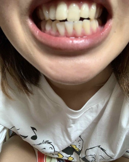 クレスト3Dホワイトニング ホワイトストリップ プロフェッショナル エフェクツ/クレスト/その他オーラルケアを使ったクチコミ(2枚目)