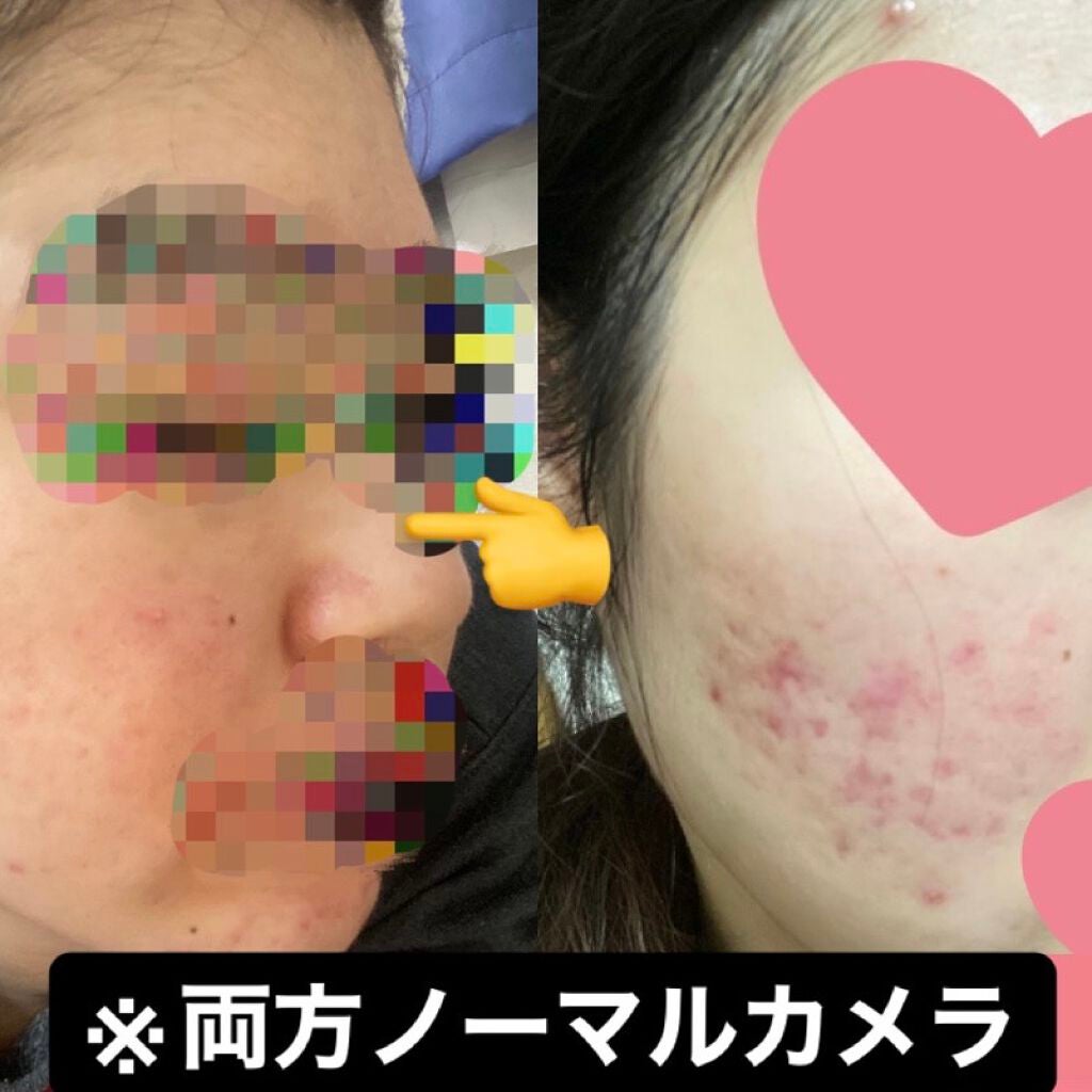 シミ・ソバカス予防ケア 乳液/キュレル/乳液を使ったクチコミ(1枚目)