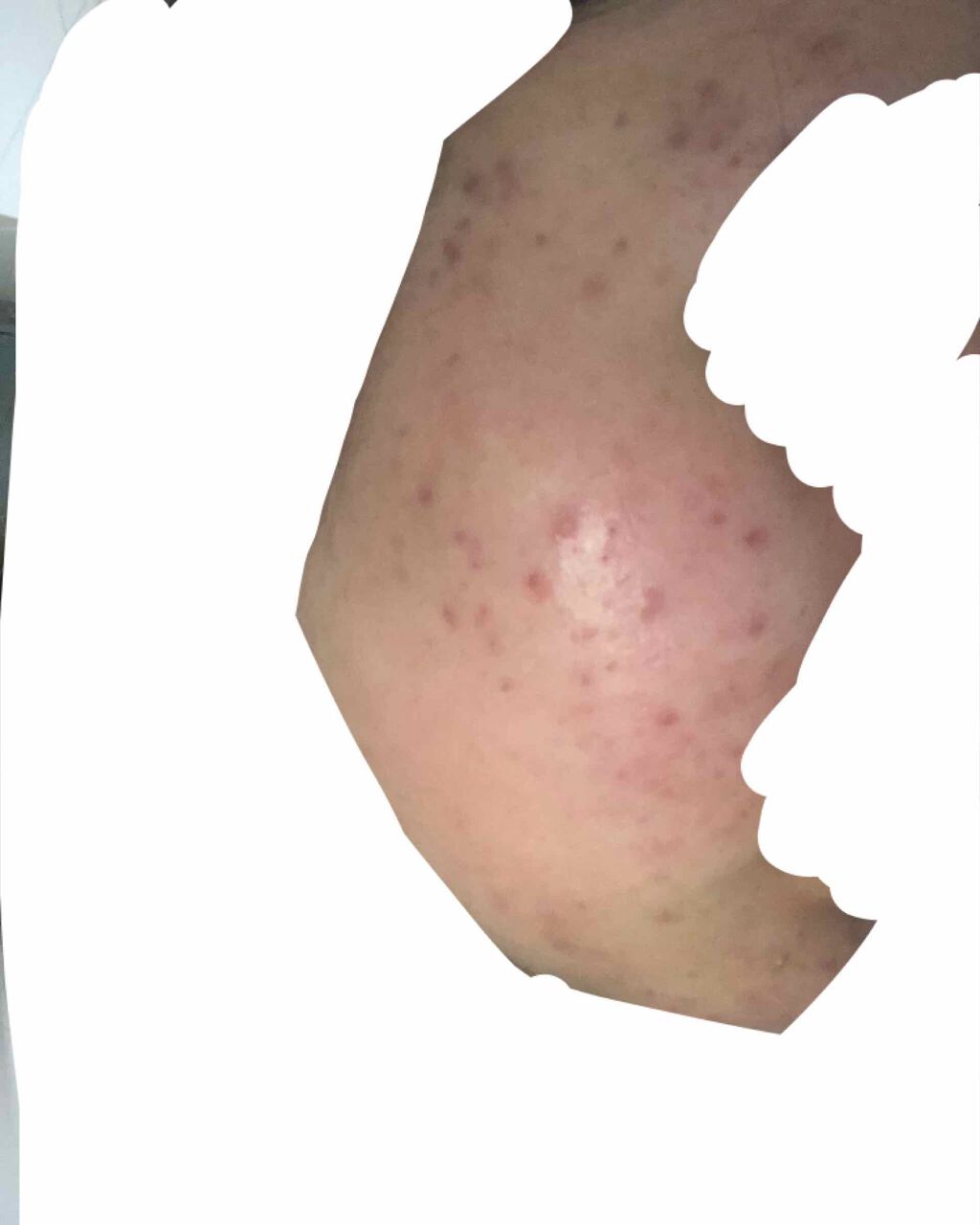 ななみ on LIPS 「皮膚科へ行き、ペピオゲルを処方してもらいました。使い始めてから..」(1枚目)