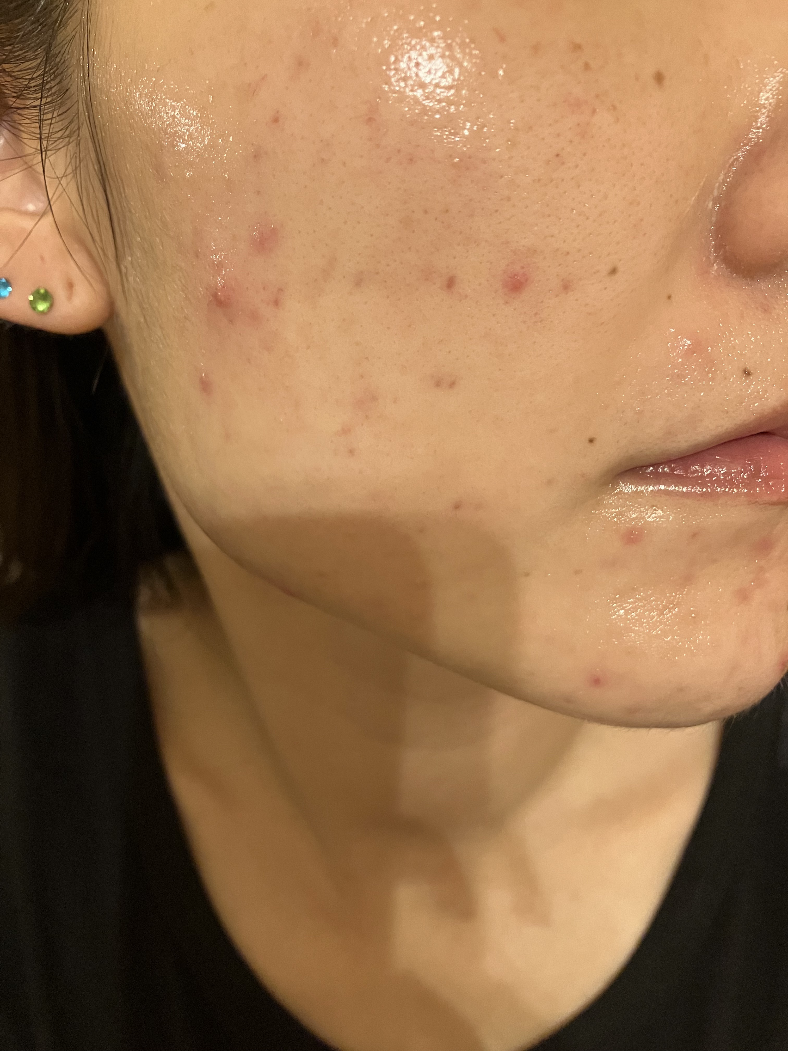 レチノールA 1% アドバンスドリバイタリゼーションクリーム/Life-flo/フェイスクリームを使ったクチコミ（2枚目）