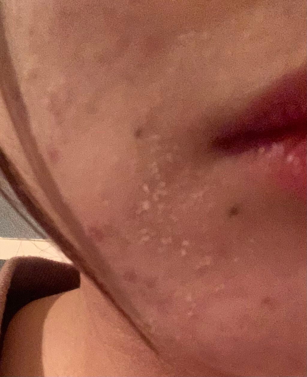 とろり on LIPS 「はい!ニキビ!!!!(写真撮影風)いや酷くなってますやん.....」(4枚目)