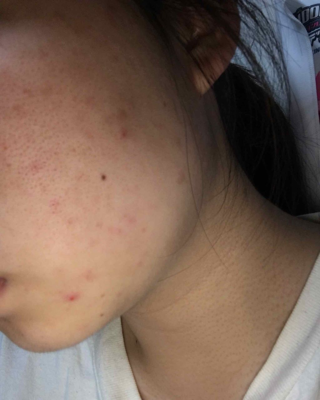 ゆめ on LIPS 「⚠️2枚目、3枚目汚肌です。2枚目がbefore3枚目がaft..」(2枚目)