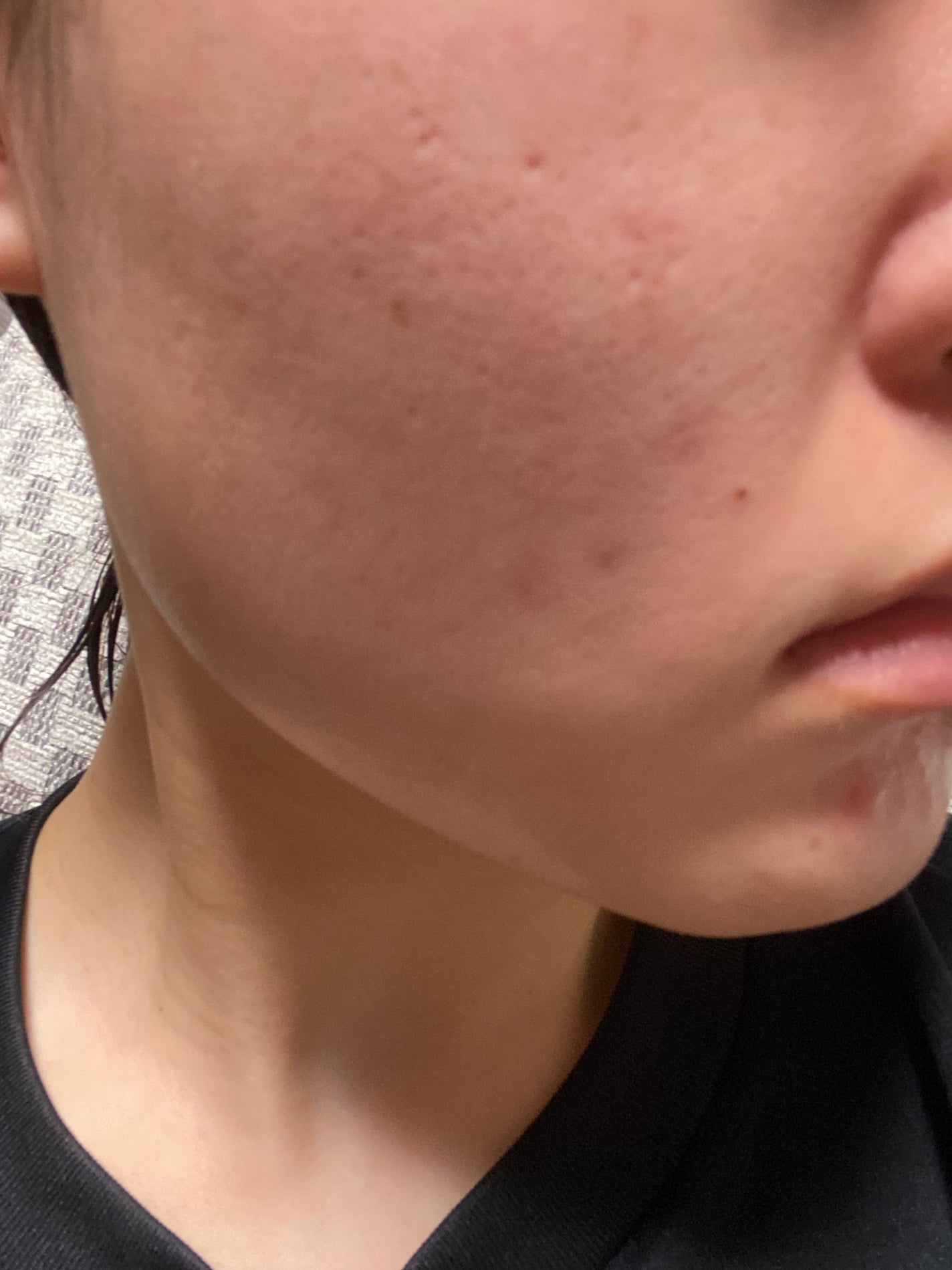 りら on LIPS 「だいぶ肌綺麗になったなぁ…(まだ全然ニキビできるし、ニキビ跡と..」(2枚目)