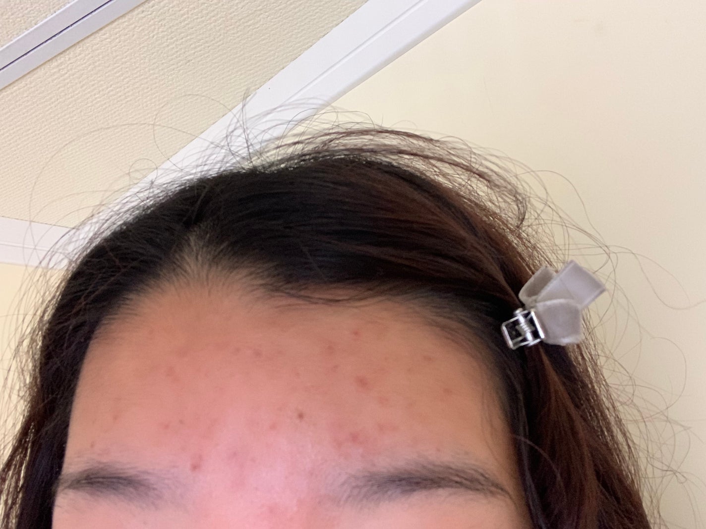 もも on LIPS 「成人式が近くておでこのニキビが治らないのですがどうしたら良いで..」(1枚目)