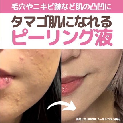 YEOUTH Glucolic Acid 30% Gel Peelのクチコミ「今回は私が定期的に使用している
買ってよかったピーリング液について
ご紹介していきたいと思いま.....」(1枚目)