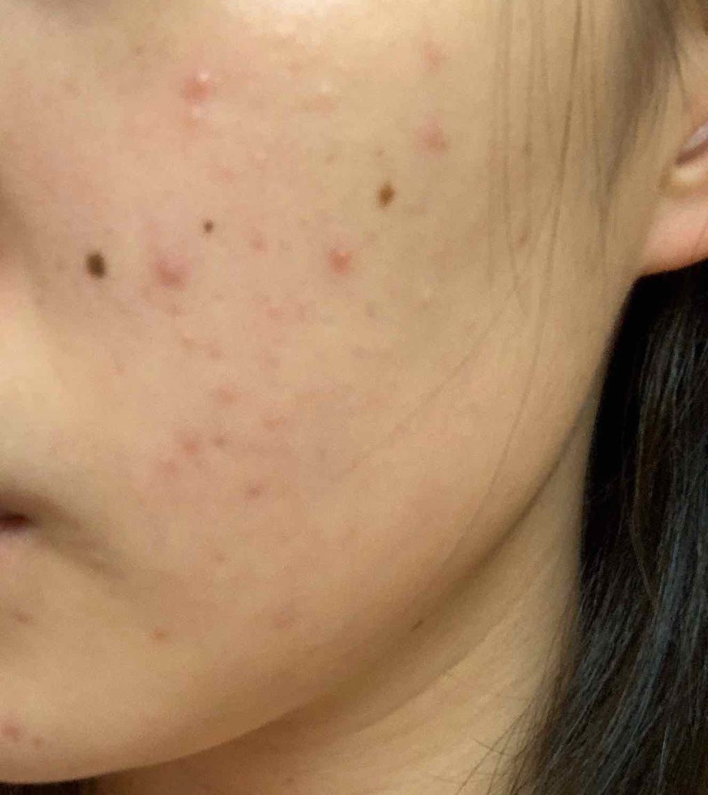 ティーツリーウォーター/ラッシュ/ミスト状化粧水を使ったクチコミ（2枚目）