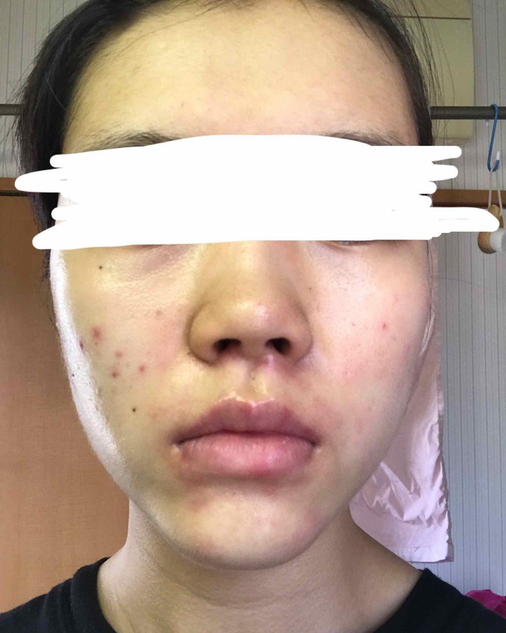 ちょこ on LIPS 「助けてください!😭ココ最近洗顔して保湿した後こんな感じになりま..」(1枚目)