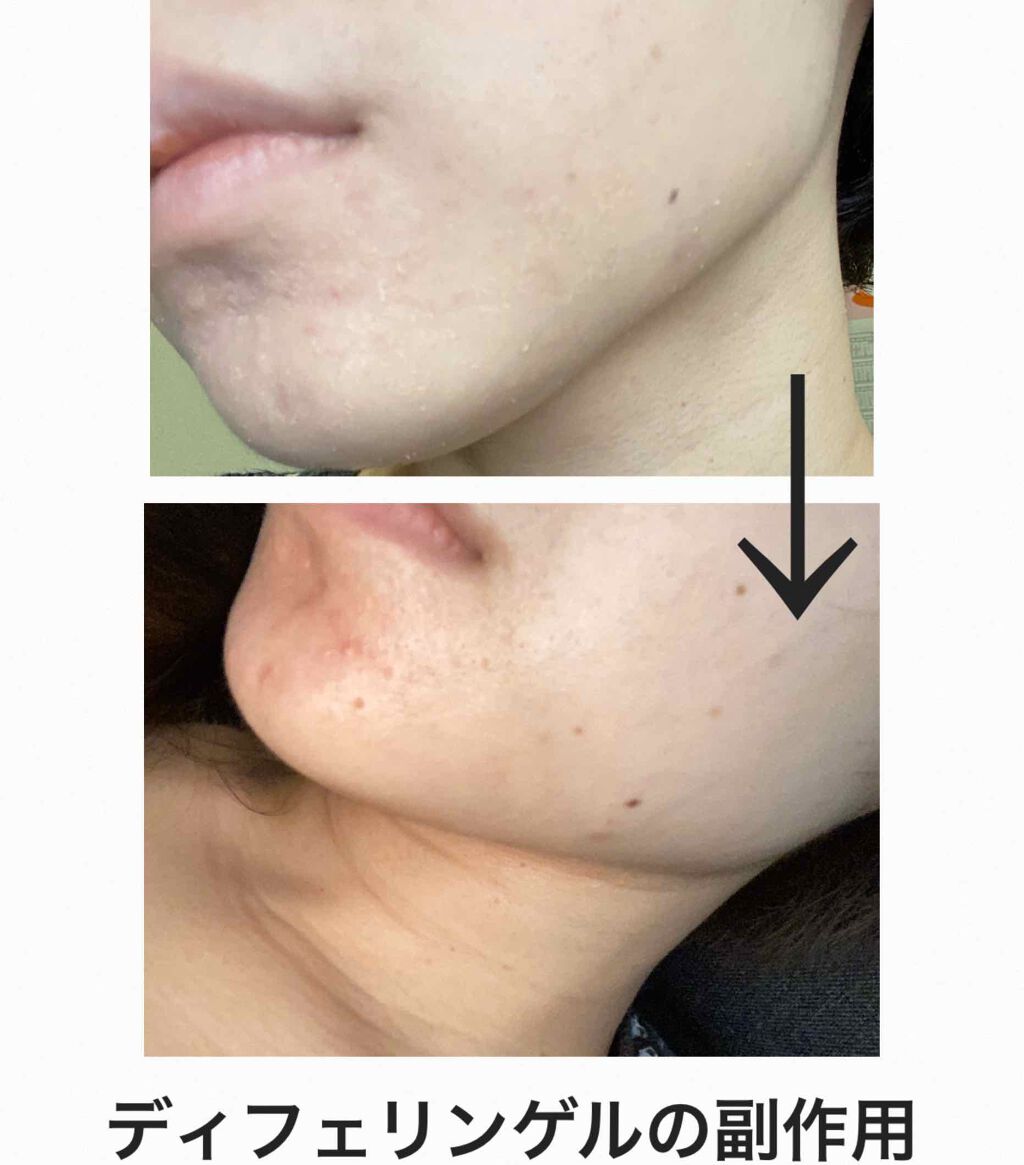 ディフェリンゲル0.1% /マルホ株式会社/その他を使ったクチコミ（2枚目）