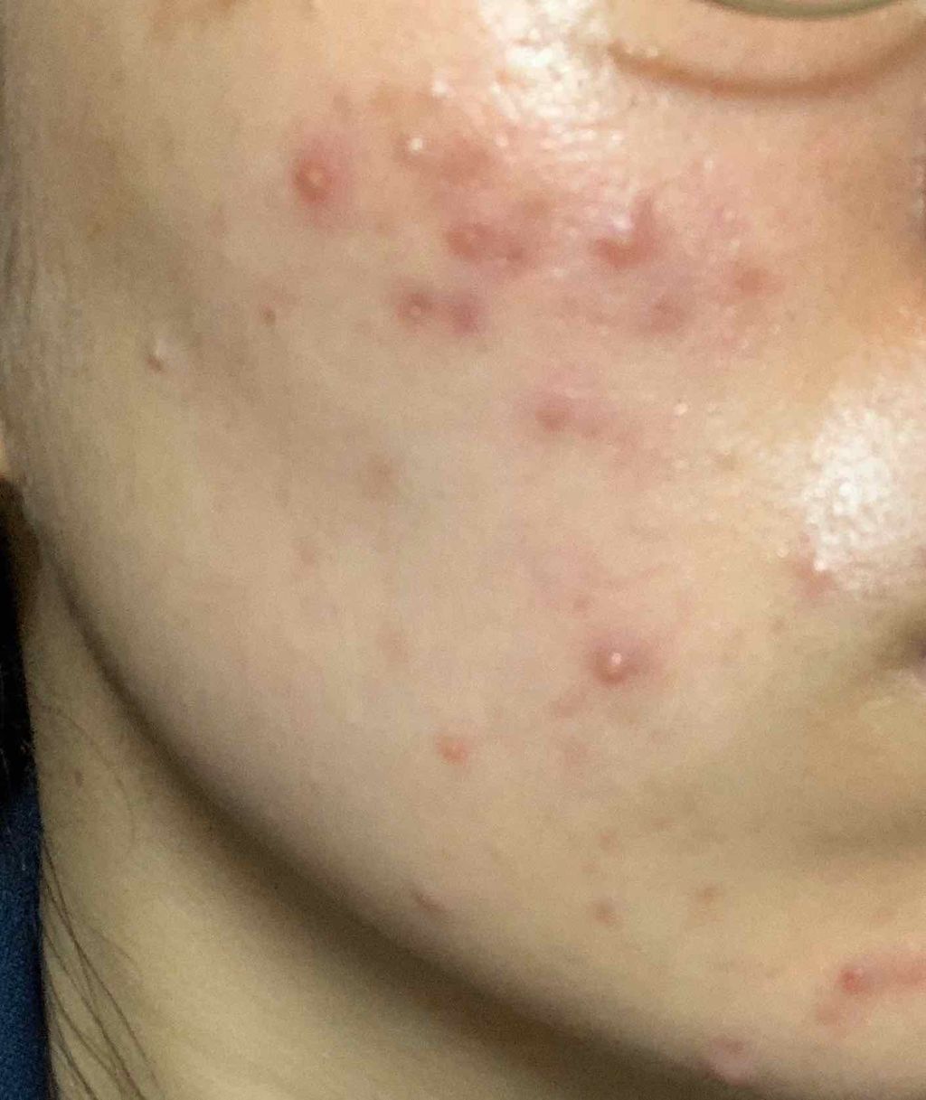 ビューティーケアマスク(ニキビ)/肌美精/シートマスク・パックを使ったクチコミ(1枚目)