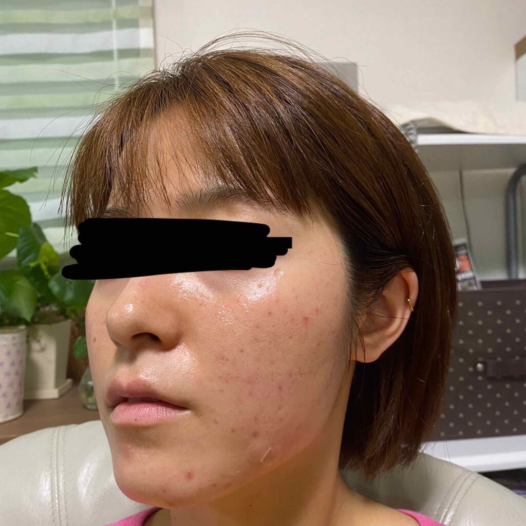 pink_beauty_a6u on LIPS 「下からとったからめちゃ顎でてるけど(笑)昨日皮膚科でニキビ潰し..」(1枚目)