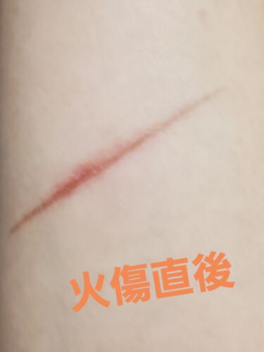 試してみた アットノン アットノンc Exクリーム 医薬品 Lips