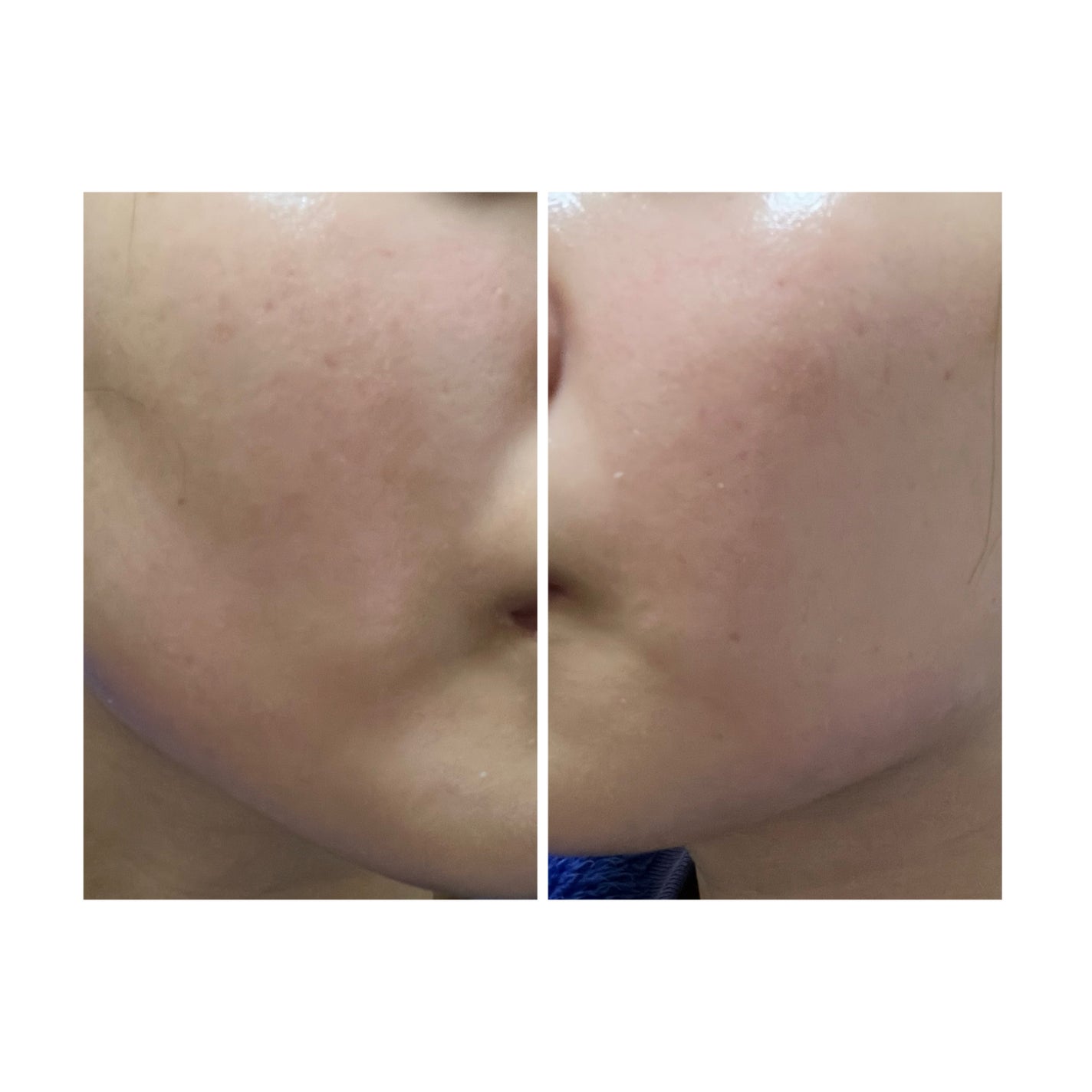 ぽむ on LIPS 「2023.9.13皮膚科に受診 エピデュオとヘパリン処方1枚目..」(4枚目)