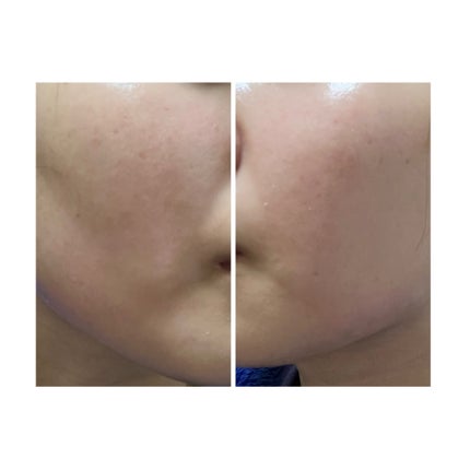 ぽむ on LIPS 「2023.9.13皮膚科に受診 エピデュオとヘパリン処方1枚目..」(4枚目)