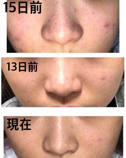 ハトムギ化粧水(ナチュリエ スキンコンディショナー R )/ナチュリエ/化粧水を使ったクチコミ(2枚目)